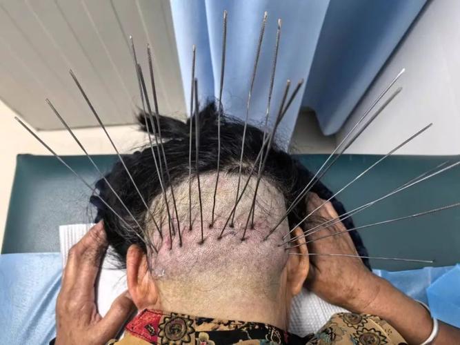 三叉神经扎针灸扎哪