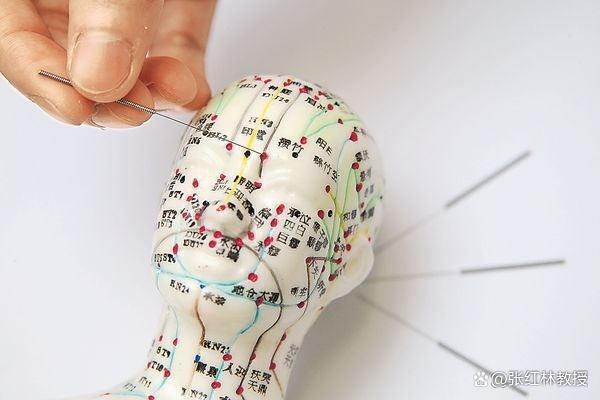 三叉神经扎针灸扎哪