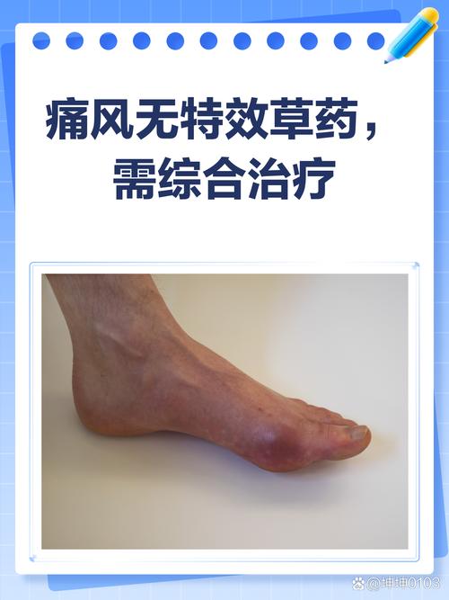 痛风怎样治疗才能断根