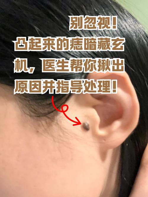 痣突出皮肤表面安全吗