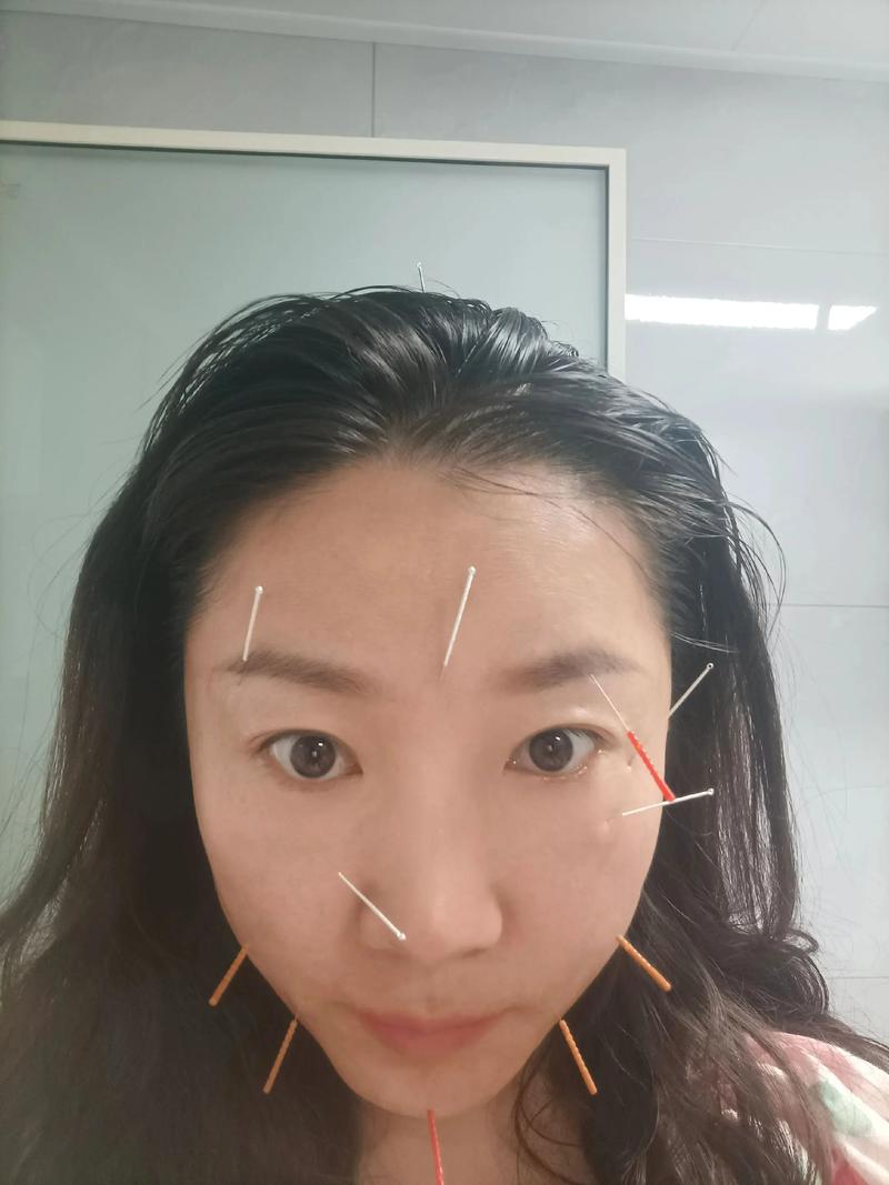 面部针灸一次多少钱