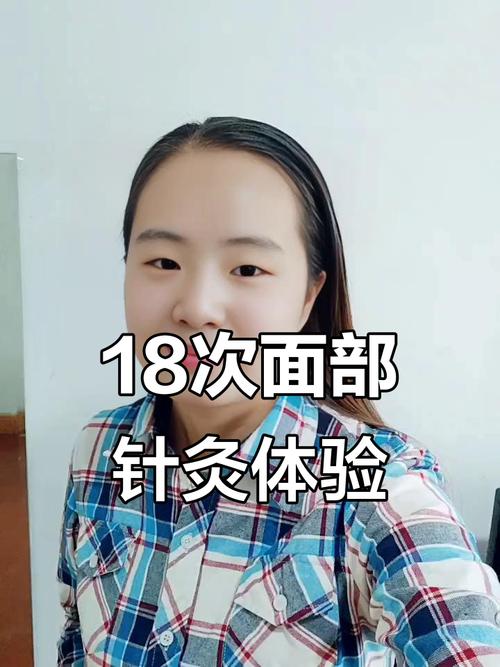 面部针灸一次多少钱