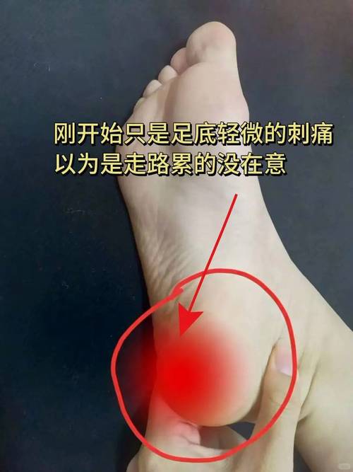 痛风会引起脚后跟疼吗