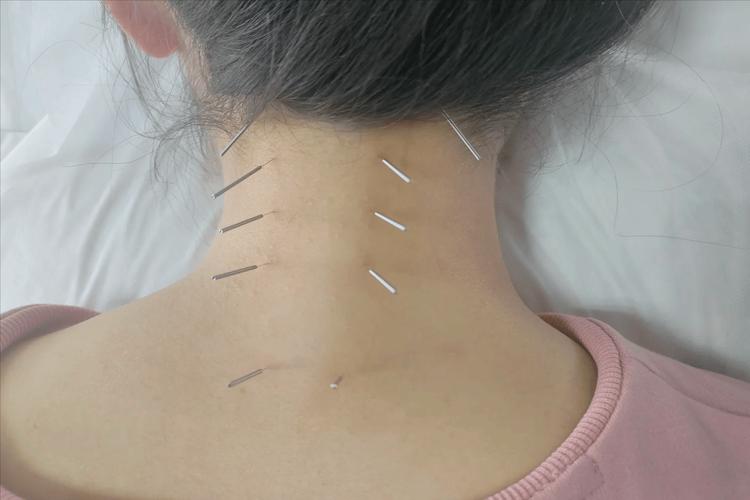 董氏针灸冶疗颈椎病