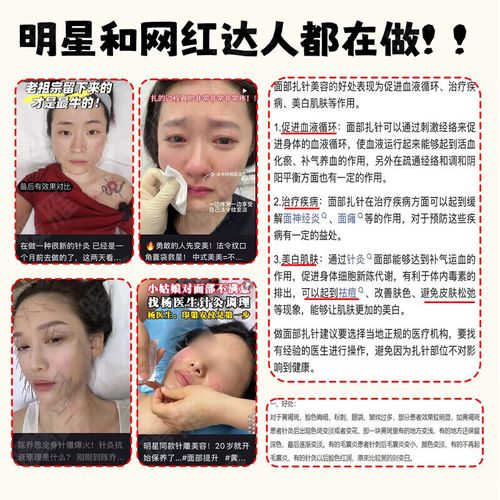 黑眼圈扎针灸有用吗