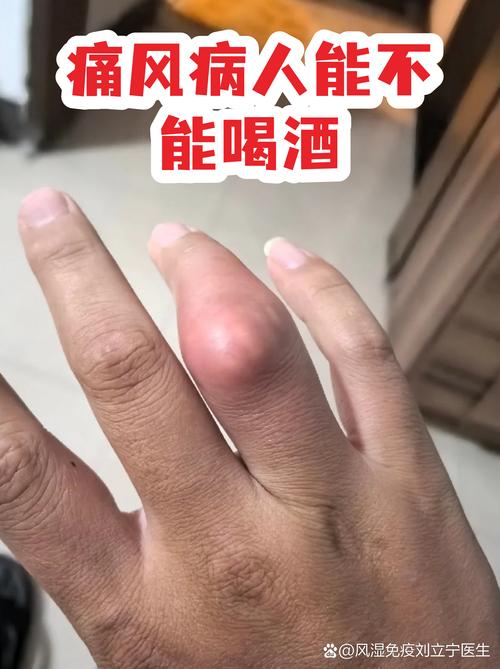 经常喝啤酒会得痛风吗