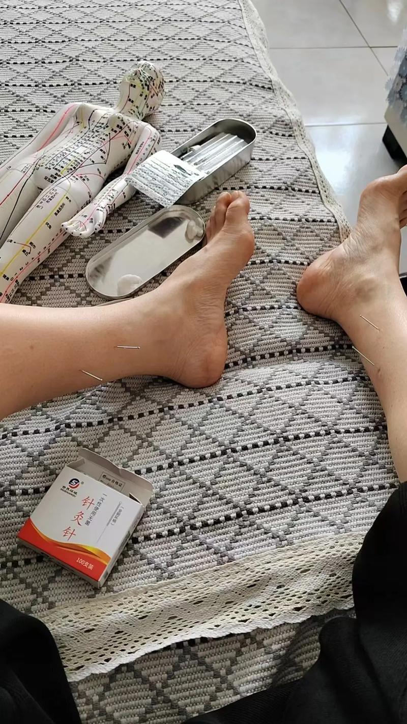 针灸治疗过敏性紫癜