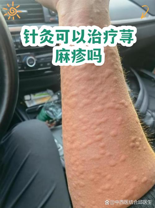 荨麻疹针灸能治好吗