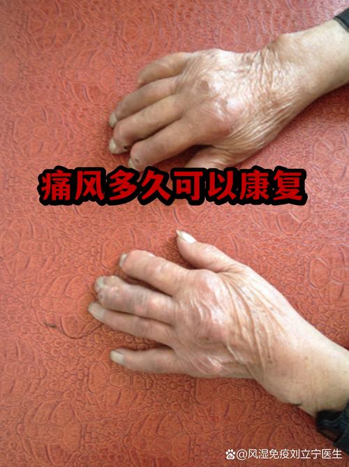 急性痛风一般几天能好