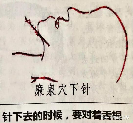 舌强不语的针灸部位