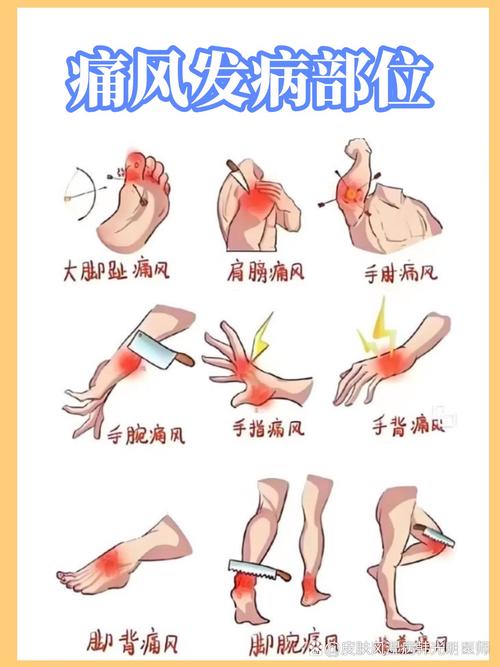 痛风的症状表现有哪些