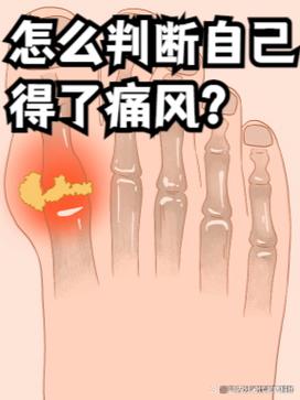大脚趾疼如何鉴别痛风