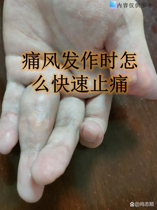 痛风急性发作 激素