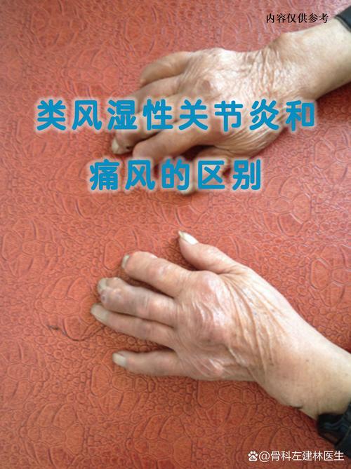 痛风与痛风性关节炎