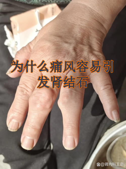痛风石和痛风一样吗