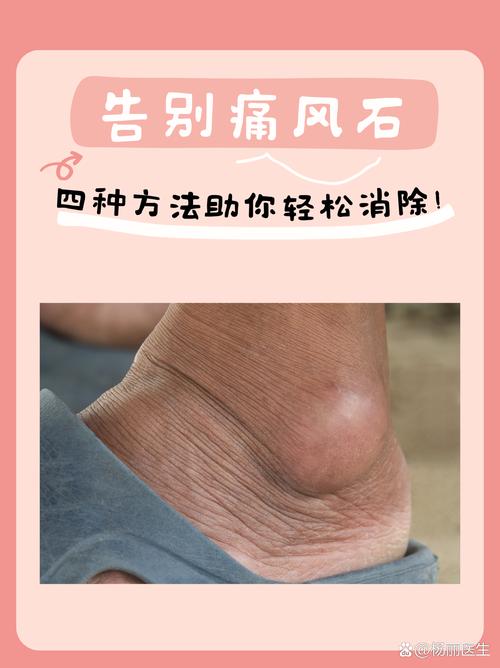 痛风多久才有痛风石