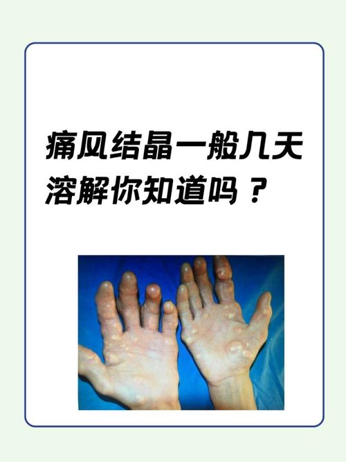 痛风多久出现痛风石