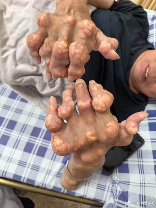 痛风多久出现痛风石