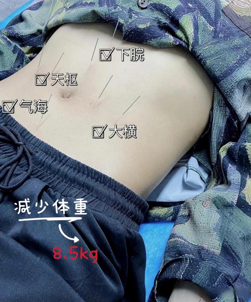瘦安针灸减肥怎么样