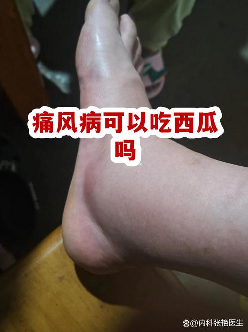 痛风可不可以吃西瓜