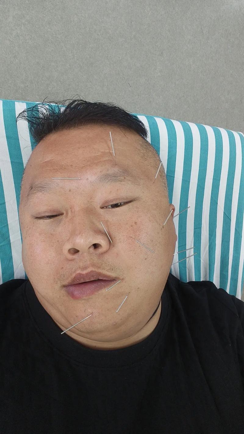 面瘫急性期能针灸吗