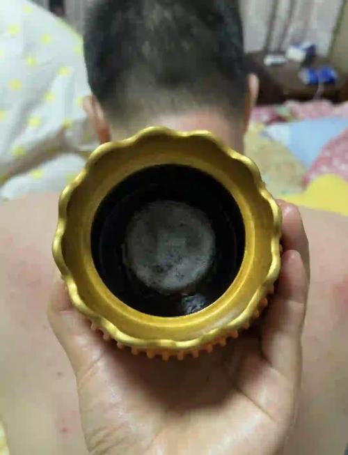 刘建秋针灸拔罐视频