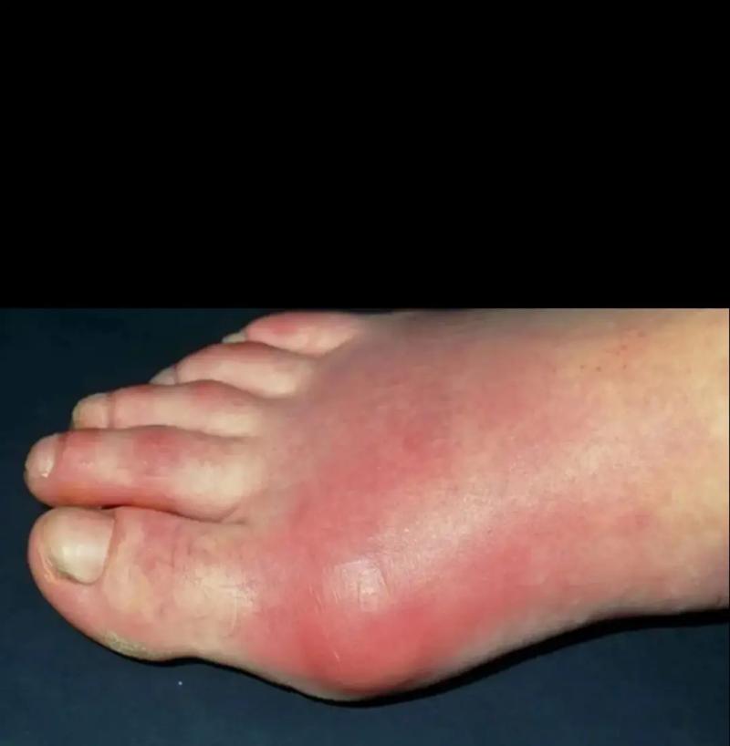 第一次痛风发作症状