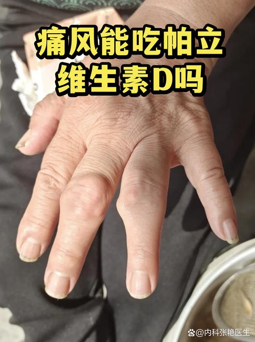 痛风与脑梗有无关系