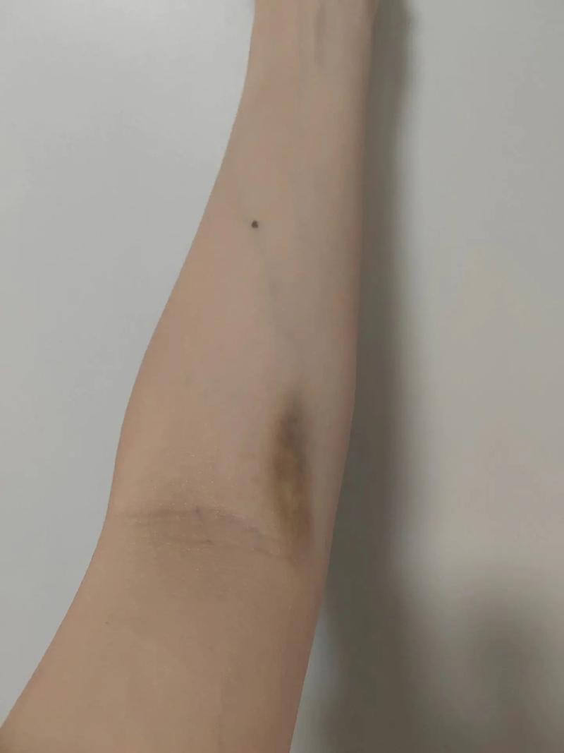 针灸后为什么有淤青