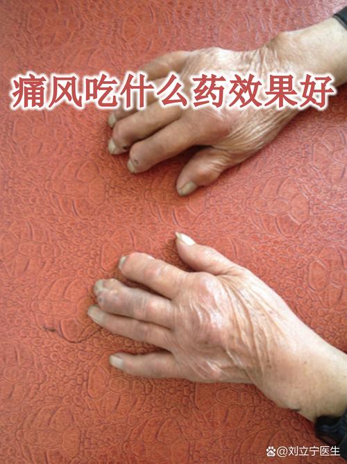 尼美舒利片治痛风吗