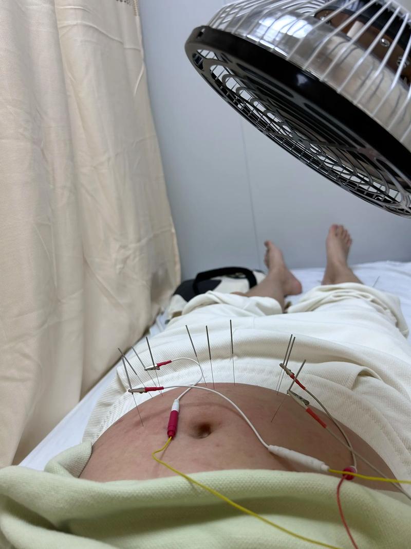 针灸能治疗妇科病吗