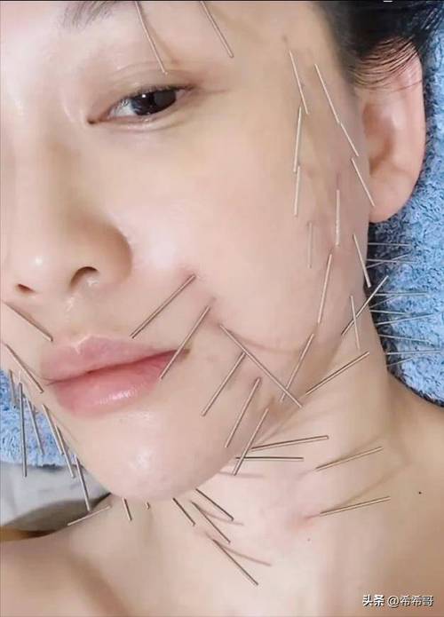 针灸瘦脸效果怎么样
