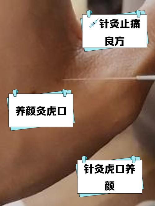 腔梗针灸能起作用吗