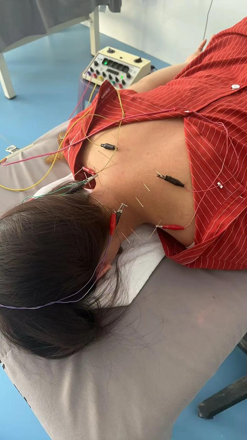 针灸治疗颈椎病图片