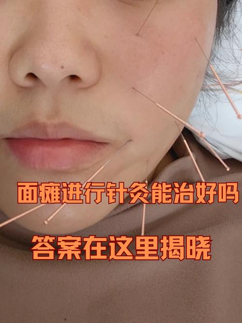 面瘫不针灸能治好吗