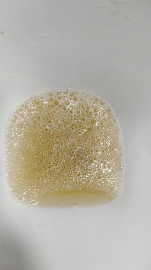 痛风病人小便泡沫多