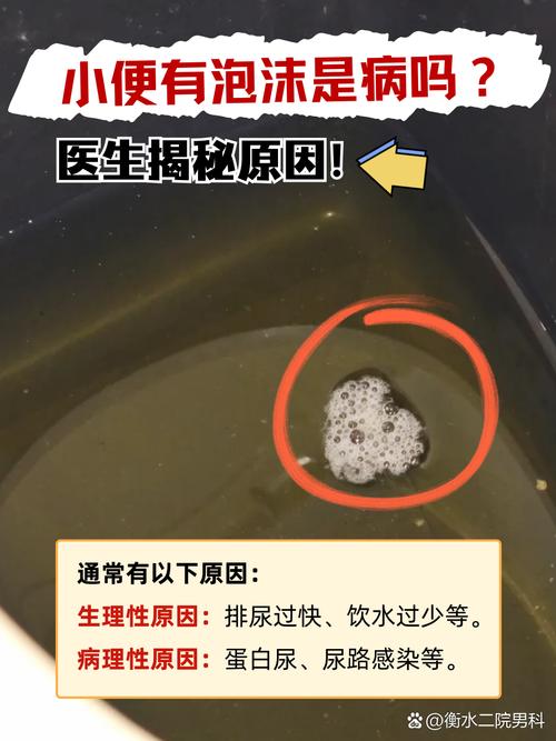 痛风病人小便泡沫多