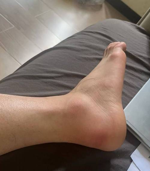 痛风的脚能多走路吗