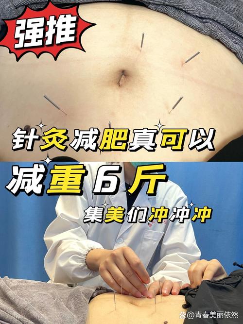 宣武中医院针灸减肥