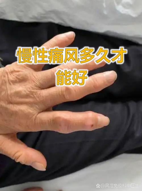 瘦的人会不会得痛风