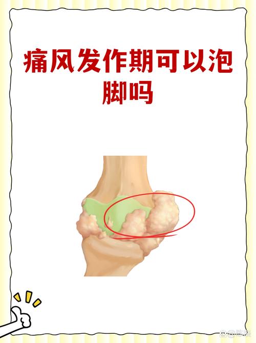 痛风可以用足疗机吗