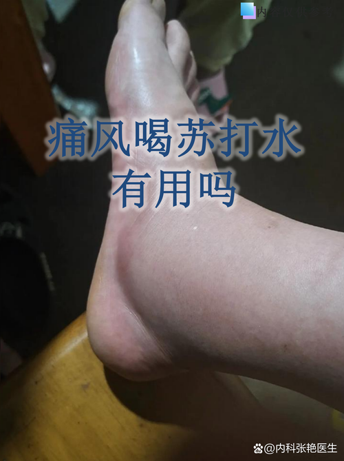 痛风可以用足疗机吗