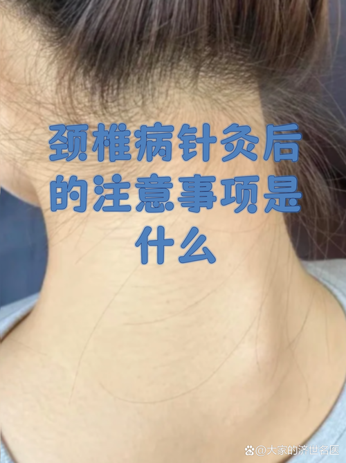 颈椎做针灸副作用吗