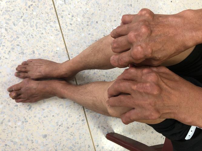 痛风急性期反复发作