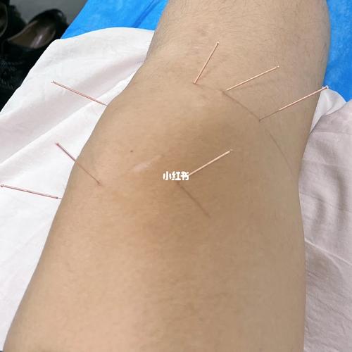 膝关节针灸图片大全