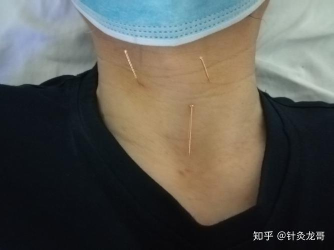 急性咽炎的针灸疗法