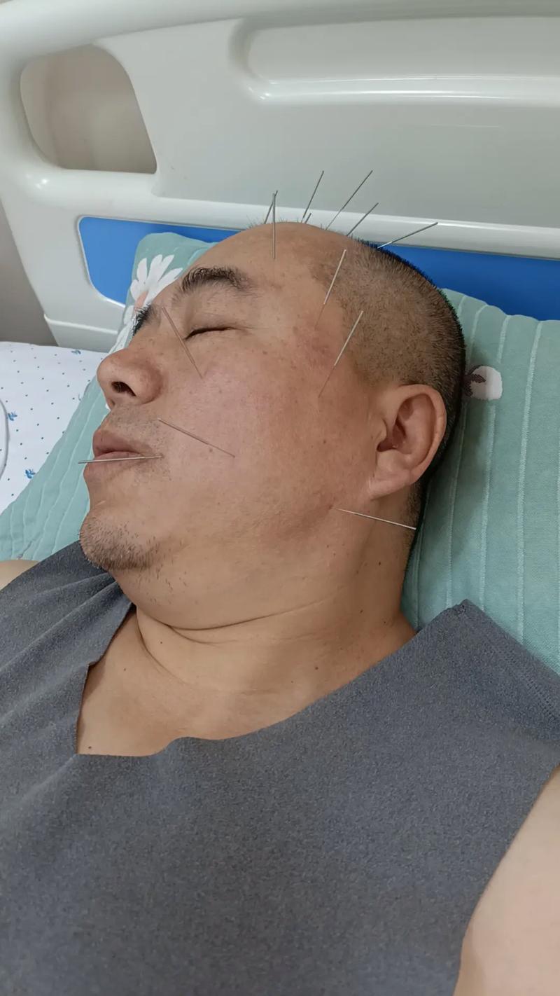 针灸后脑鸣更严重了