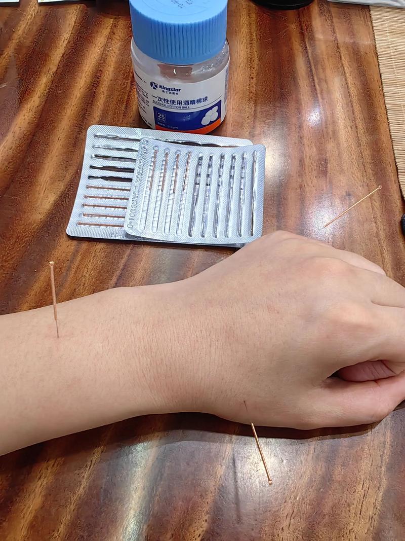 针灸治头疼能去根吗