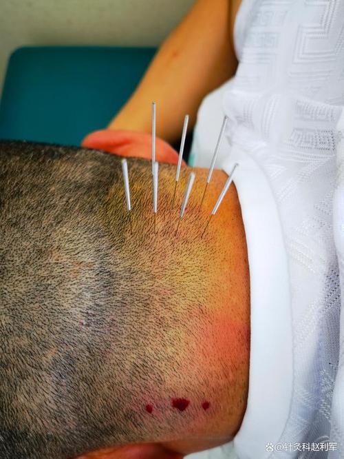 针灸治头疼能去根吗