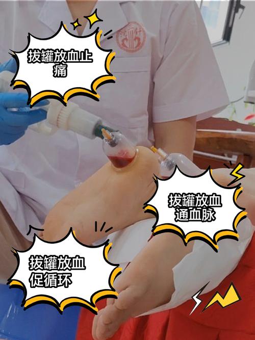 拔血罐能治疗痛风吗